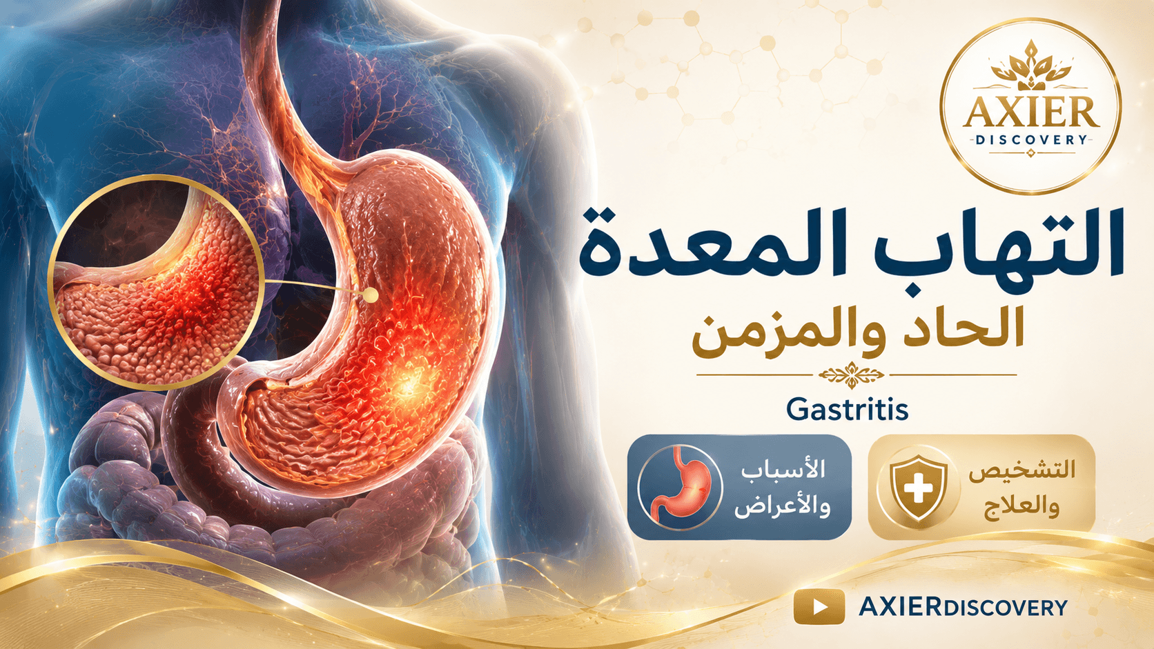 صورة توضيحية لالتهاب المعدة الحاد والمزمن