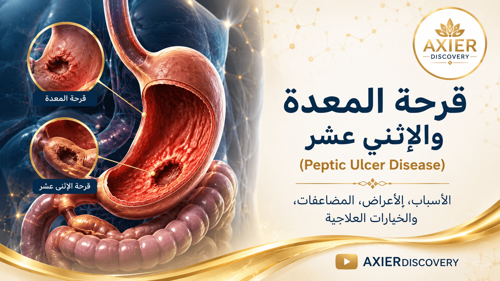 صورة توضيحية لقرحة المعدة والإثني عشر، تُظهر مواضع القرحة داخل الجهاز الهضمي – AXIER Discovery